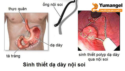 Nội soi dạ dày và sinh thiết được coi là tiêu chuẩn chẩn đoán xác định cho bệnh ung thư dạ dày. 