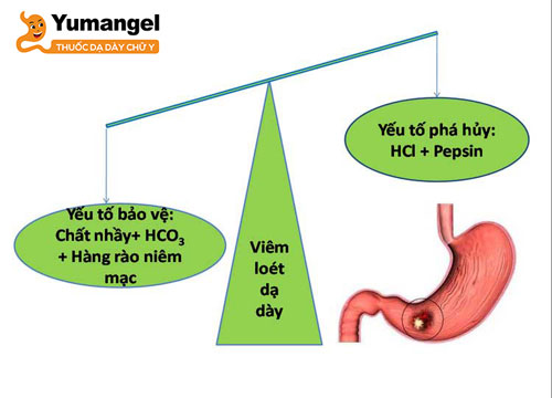 Viêm loét dạ dày xảy ra khi có sự mất cân bằng giữa dịch tiêu hóa do dạ dày sản xuất và các yếu tố khác nhau bảo vệ niêm mạc dạ dày. 