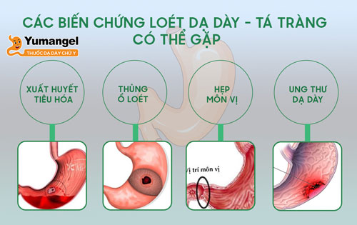 Điều trị viêm loét dạ dày bằng thuốc. 