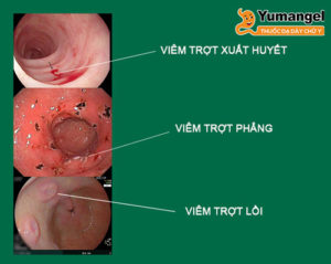 Ở giai đoạn viêm loét dạ dày cấp độ 1, niêm mạc dạ dày bị xung huyết sau đó hình thành các vết trầy xước. 