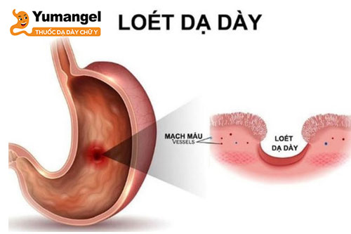 Viêm loét dạ dày cấp độ 2 là khi các vết loét ăn mòn dần vào thành dạ dày nhưng chưa đi qua lớp niêm mạc.