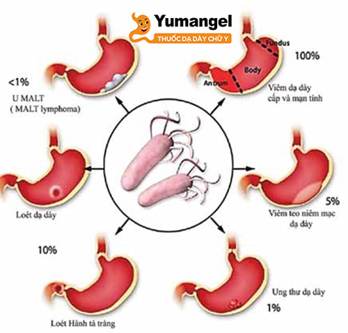 Bệnh dạ dày có thể lây nhiễm nếu nguyên nhân gây bệnh là do nhiễm trùng HP. 