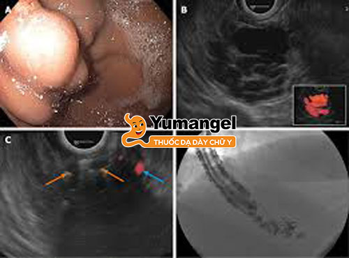 Hình ảnh nội soi rõ ràng, sắc nét giúp chẩn đoán bệnh chính xác. 