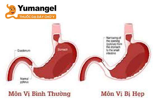 Hình ảnh hẹp môn vị dạ dày. 