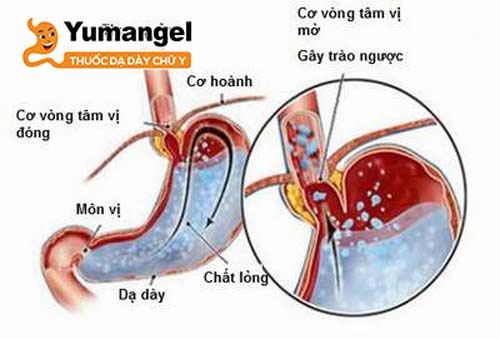 Hình ảnh tuyết rơi trong hẹp môn vị qua chụp X – quang. 