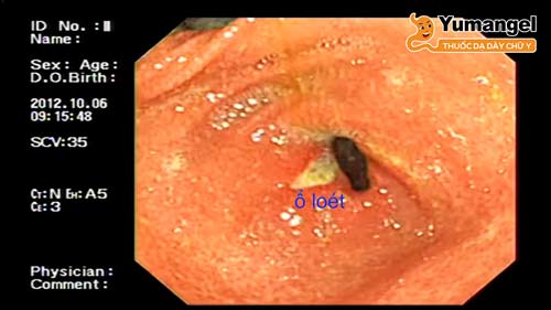 Loét tiền môn vị phát triển ở đường tiêu hóa trên, ở khu vực phía trên môn vị.