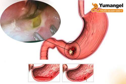 Thủng dạ dày có thể là biến chứng nghiêm trọng của loét tiền môn vị dạ dày.