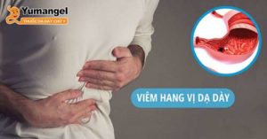 Các mẹo chữa viêm hang vị dạ dày tại nhà chì phù hợp với tình trạng bệnh nhẹ. 