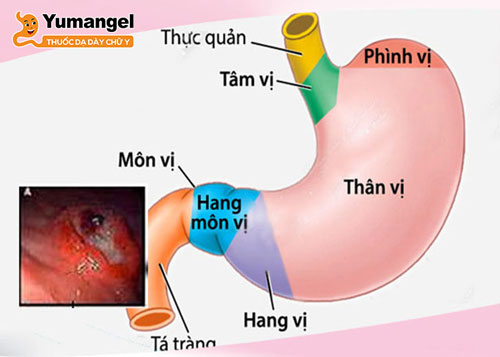 Điều trị viêm hang vị dạ dày bằng cách thay đổi thói quen ăn uống sinh hoạt kết hợp dùng thuốc theo chỉ định của bác sĩ. 