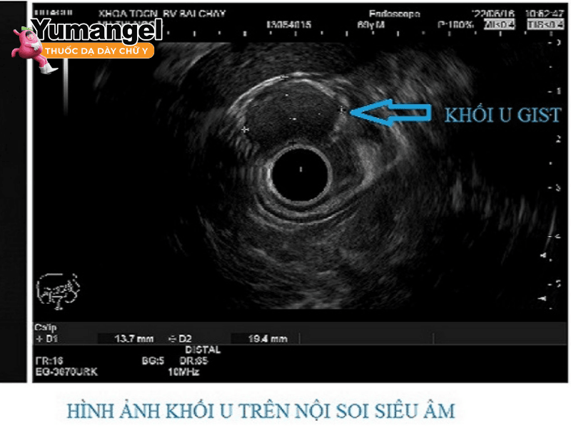 Nội soi siêu âm được dùng để chẩn đoán u dưới niêm mạc dạ dày