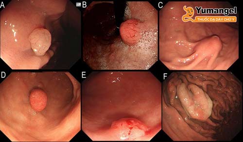 Hình ảnh polyp dạ dày. 