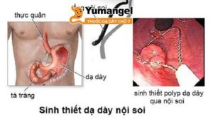 Sinh thiết polyp dạ dày qua nội soi. 