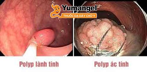 Sinh thiết polyp để xác định xem sự phát triển là ung thư hay lành tính đồng thời phát hiện và tầm soát bệnh ung thư dạ dày.