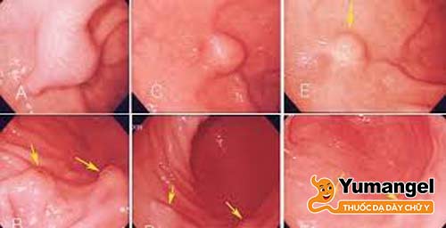 Hình ảnh u dưới niêm mạc dạ dày. 