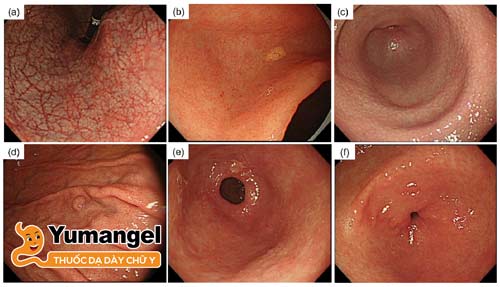 Hình ảnh niêm mạc dạ dày bị viêm teo. 