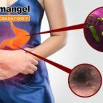 Viêm teo niêm mạc dạ dày C1 thường do vi khuẩn H.pylori.