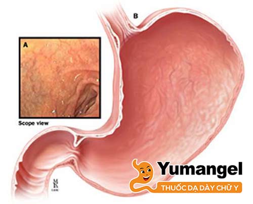 Bệnh viêm teo niêm mạc dạ dày C1 tự miễn phát triển khi cơ thể vô tình tạo ra các kháng thể tấn công các tế bào dạ dày khỏe mạnh. 