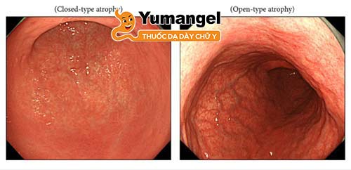 Viêm teo niêm mạc dạ dày không được điều trị có thể gây biến chứng viêm dạ dày xuất huyết, ung thư biểu mô dạ dày… 