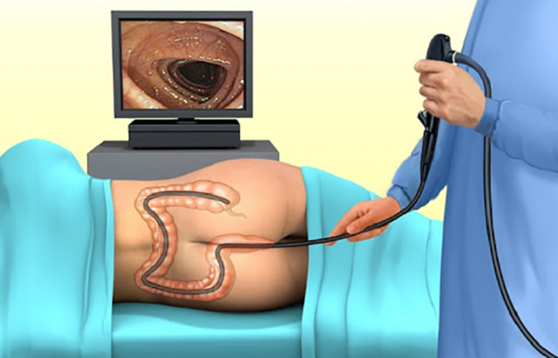 Giá nội soi đại tràng Bệnh viện Bạch Mai