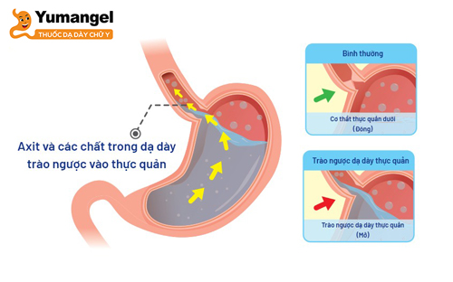 Trào ngược axit thường gây đau ở ngực và cổ họng, thường được gọi là chứng ợ nóng kèm đau thượng vị. 