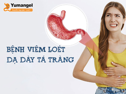 Loét dạ dày tá tràng khiến người bệnh đau vùng thượng vị, đau dạ dày, mệt mỏi…