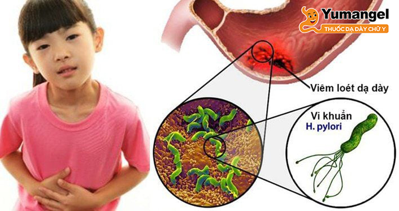 Viêm dạ dày HP ở trẻ em kéo dài có thể trở thành mãn tính dẫn đến loét dạ dày và chảy máu dạ dày. 