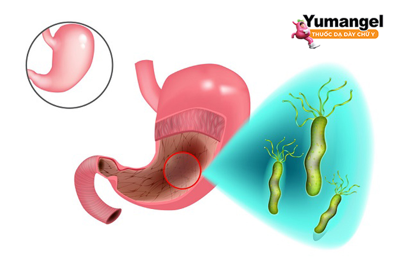 Vi khuẩn HP là một trong nguyên nhân hàng đầu gây viêm loét dạ dày tá tràng. 