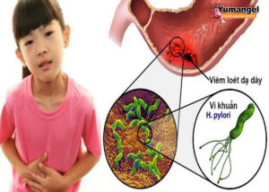 Điều trị viêm loét dạ dày HP dương tính