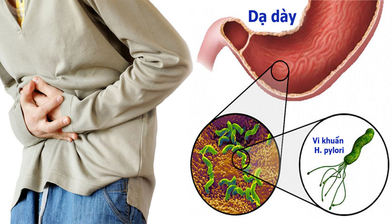 điều trị viêm loét dạ dày hp dương tính