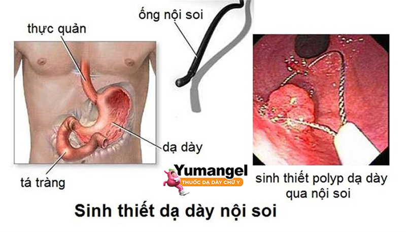 Nội soi sinh thiết dạ dày chẩn đoán HP.