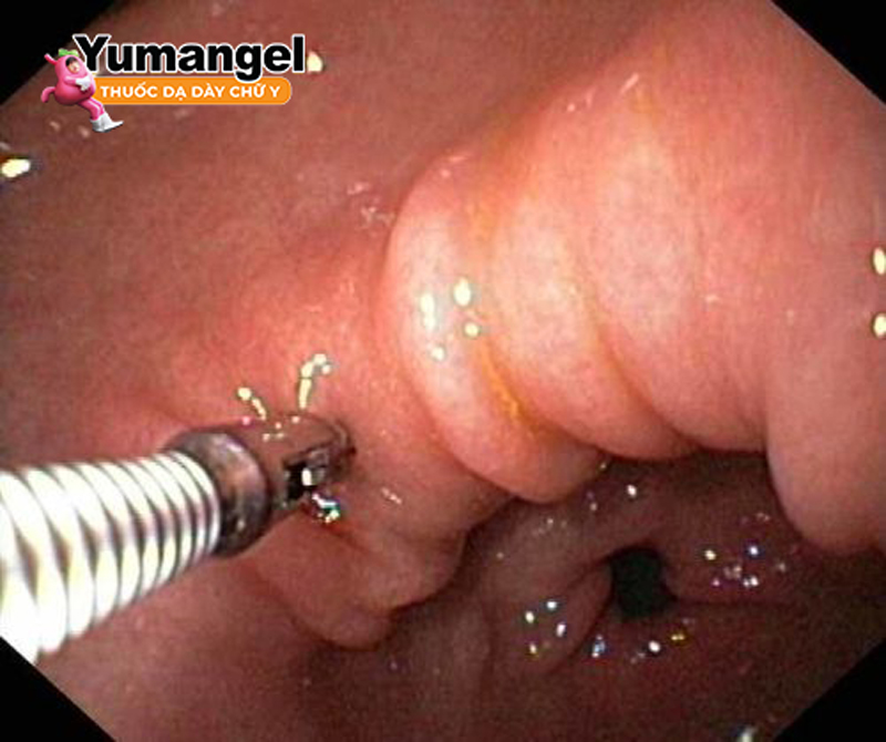 Nội soi sinh thiết đường tiêu hóa trên giúp chẩn đoán đã điều trị được vi khuẩn HP hay chưa. 