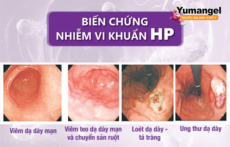 Chủ động phòng ngừa nhiễm trùng HP là điều quan trọng để tránh xảy ra các biến chứng nguy hiểm như ung thư dạ dày.