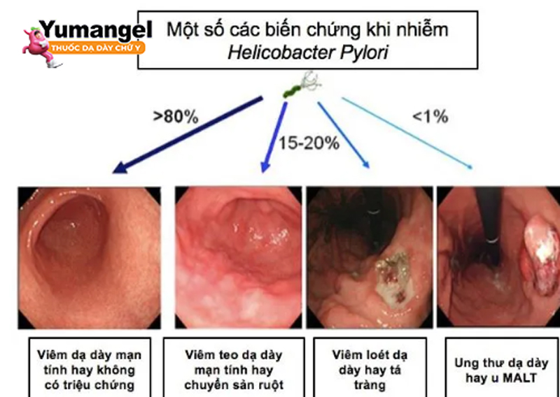 Vi khuẩn HP là một trong các nguyên nhân gây ra các bệnh lý ở dạ dày. 