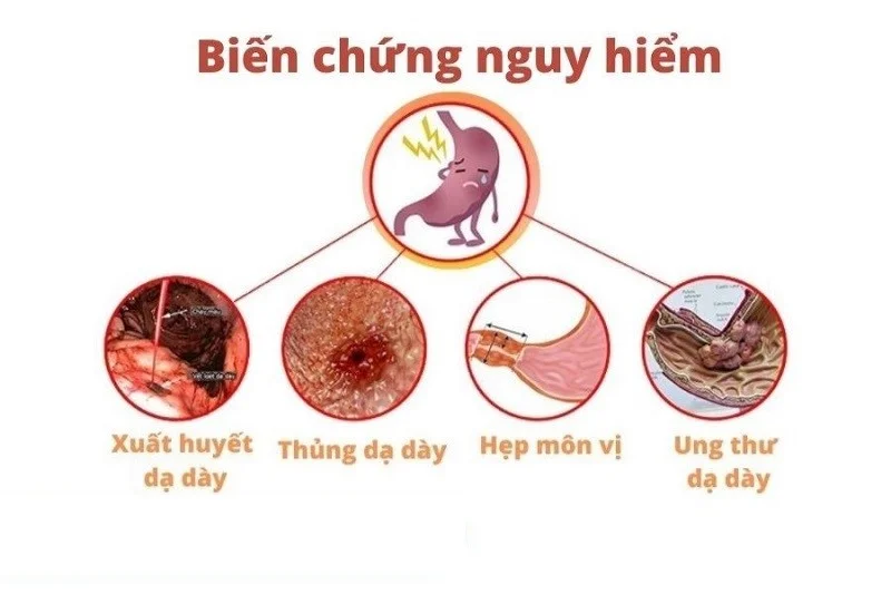 khoảng cách giữa 2 lần nội soi dạ dày​ là an toàn nhất