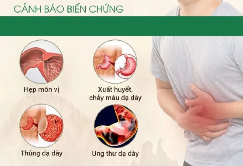 thuốc bảo vệ dạ dày khi uống kháng sinh 2