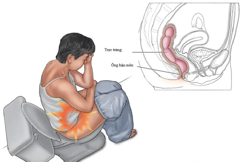 Triệu chứng đau hậu môn