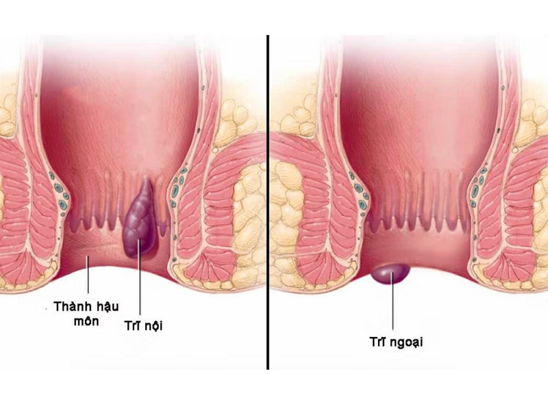 bệnh trĩ khiến người bệnh cảm thấy khó chịu sau mỗi lần đại tiện