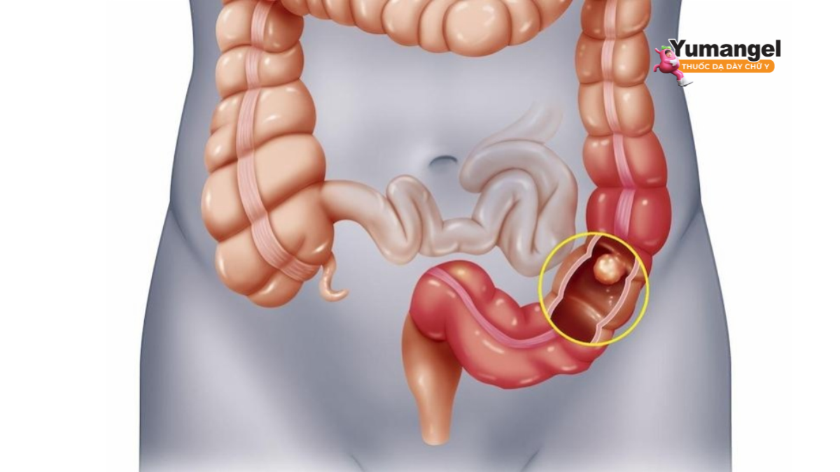 U đại tràng là các khối mô tăng sinh (tăng trưởng bất thường của tế bào)