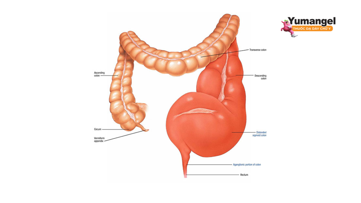 Nguyên nhân gây bệnh Hirschsprung liên quan đến sự phát triển phôi thai