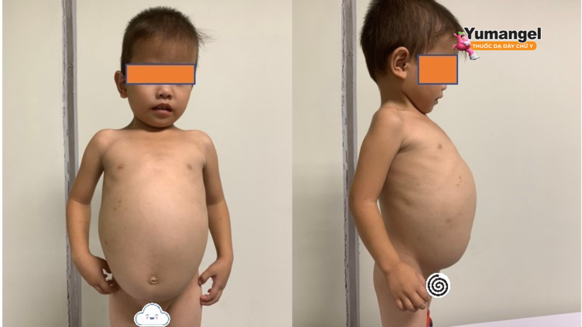 Cơ chế gây phình đại tràng bẩm sinh (bệnh Hirschsprung)