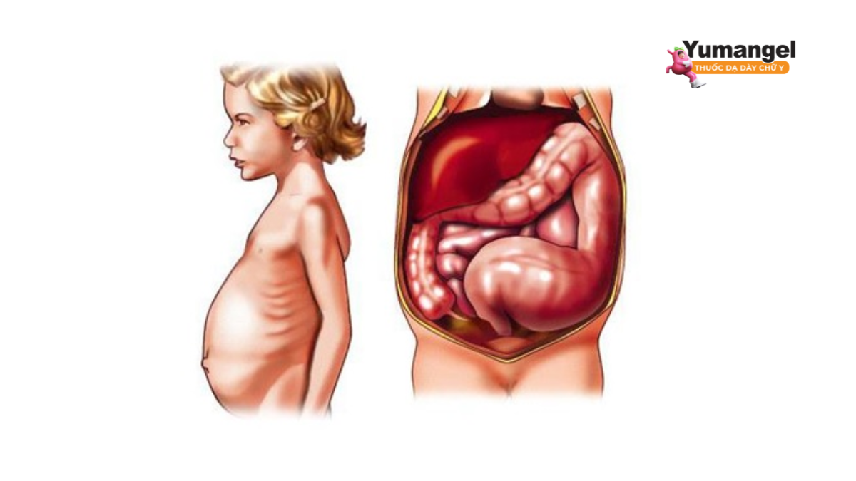 Bụng chướng và gầy gò là dấu hiệu của bệnh ở trẻ lớn