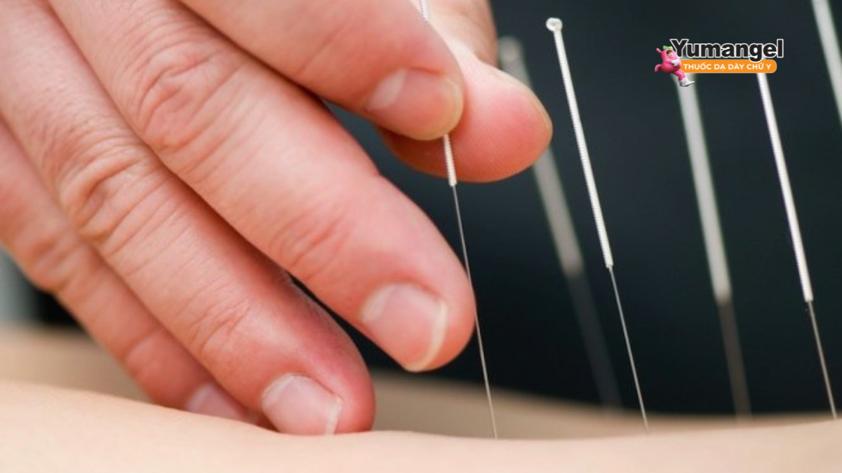 Phương pháp châm cứu giúp làm dịu các triệu chứng như đầy bụng, chậm tiêu, đồng thời thúc đẩy nhu động ruột hoạt động hiệu quả hơn