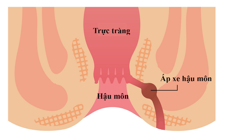 Áp xe hậu môn 