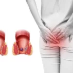 các bệnh về hậu môn