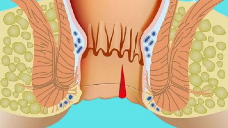 Nứt kẽ hậu môn