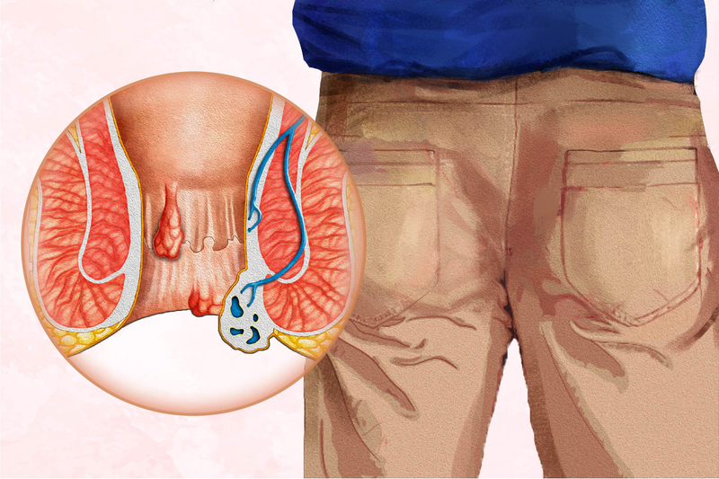 Suy giãn tĩnh mạch hậu môn