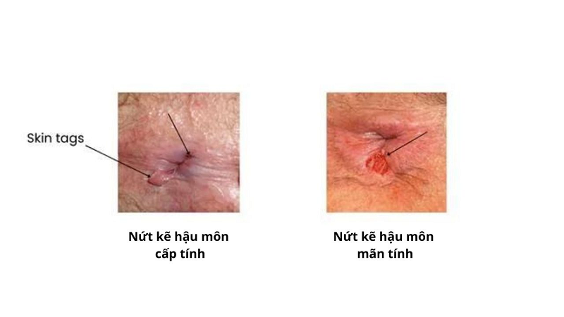 hậu môn chảy dịch