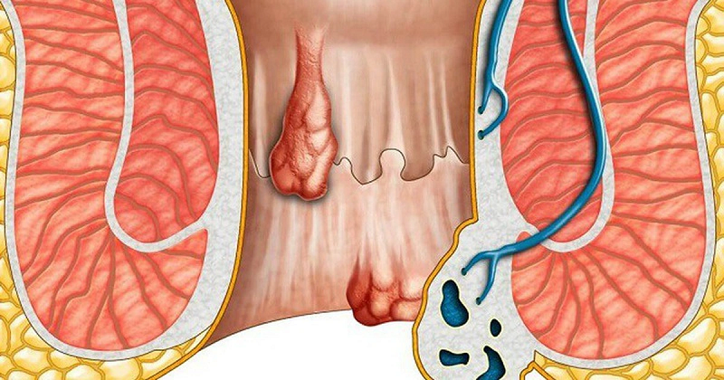 hậu môn chảy dịch