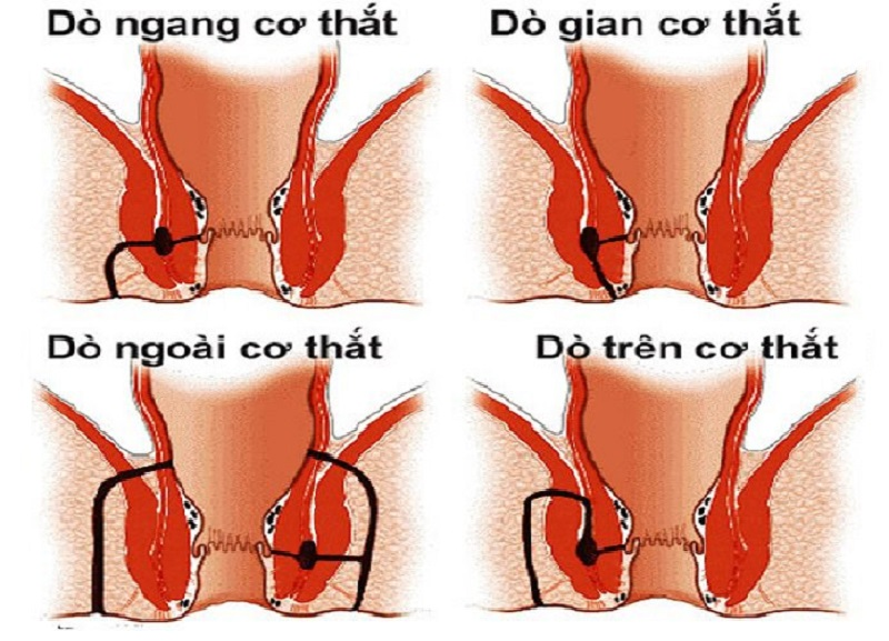 hậu môn chảy dịch vàng