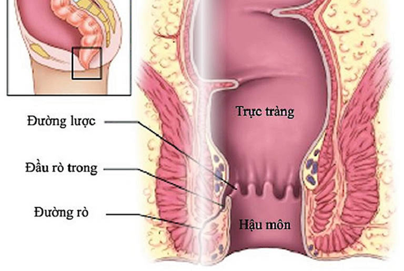hậu môn chảy dịch vàng